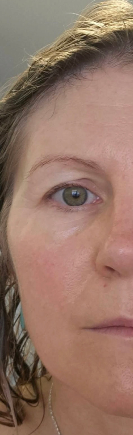 Half-face photograph on Day 31